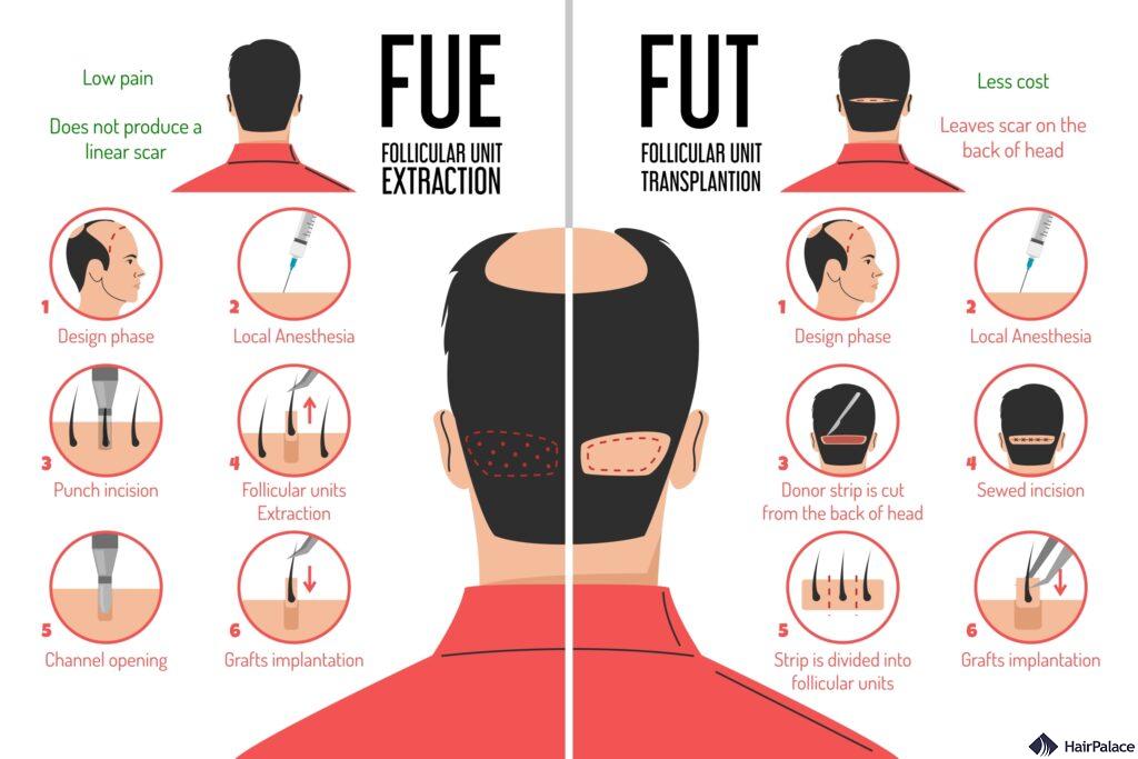 fue and fut procedures