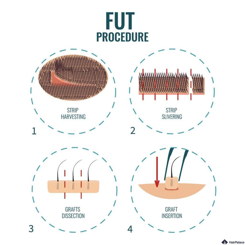 fut hair transplant process is ideal for a hairline transplant