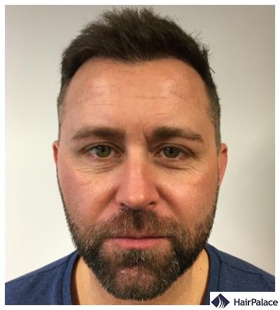final FUE hair transplant result 12 months after treatment
