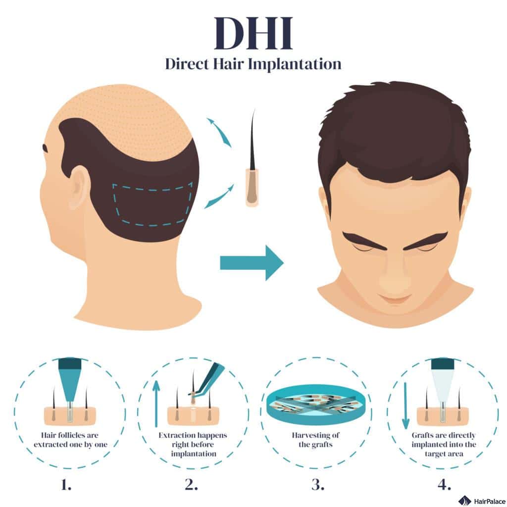 How does DHI hair transplant work? 