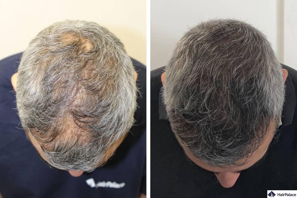 FUE hair transplant London