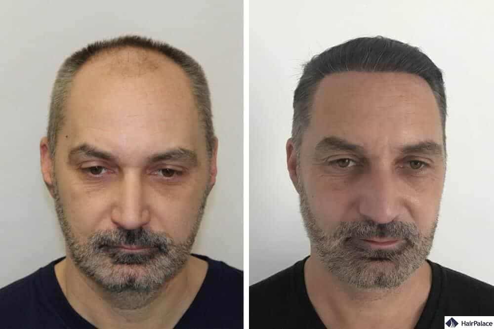 London amazing hair transplant result