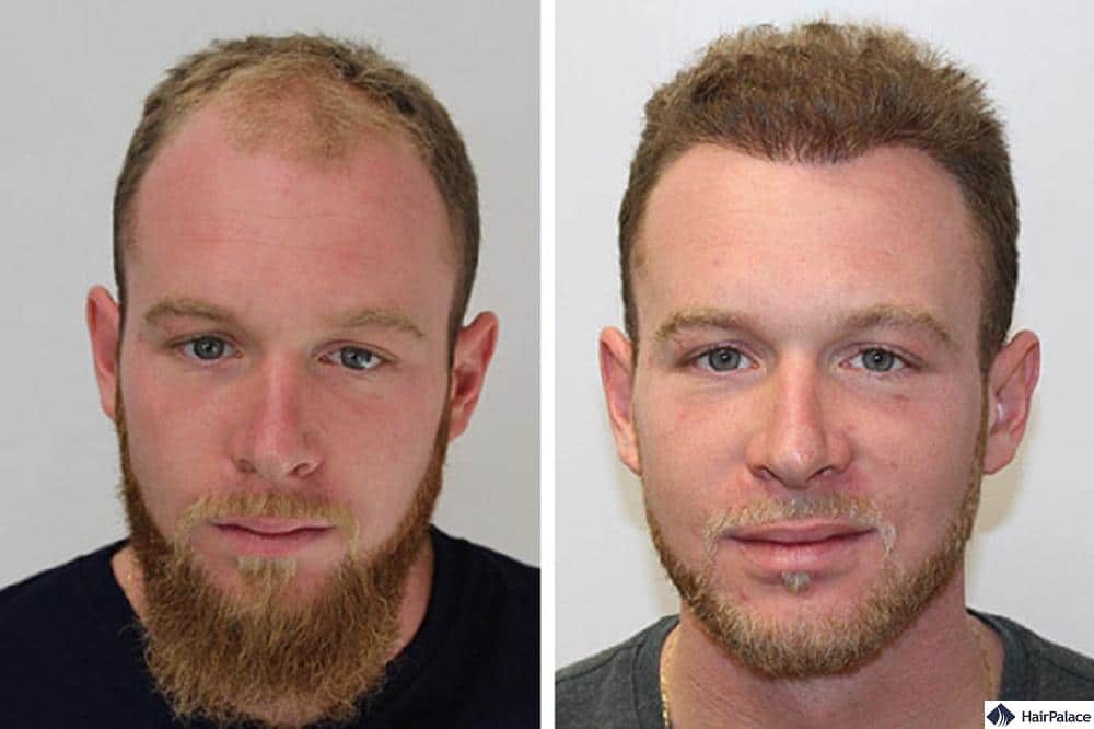 hair transplant in Australia