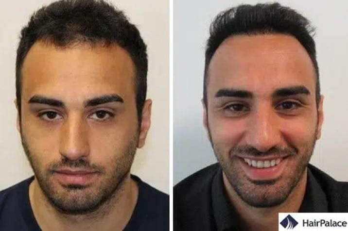 Hair Transplant in Istanbul | TOP 10 Clinics in 2023 Hair Transplant in Istanbul | TOP 10 Clinics in 2023