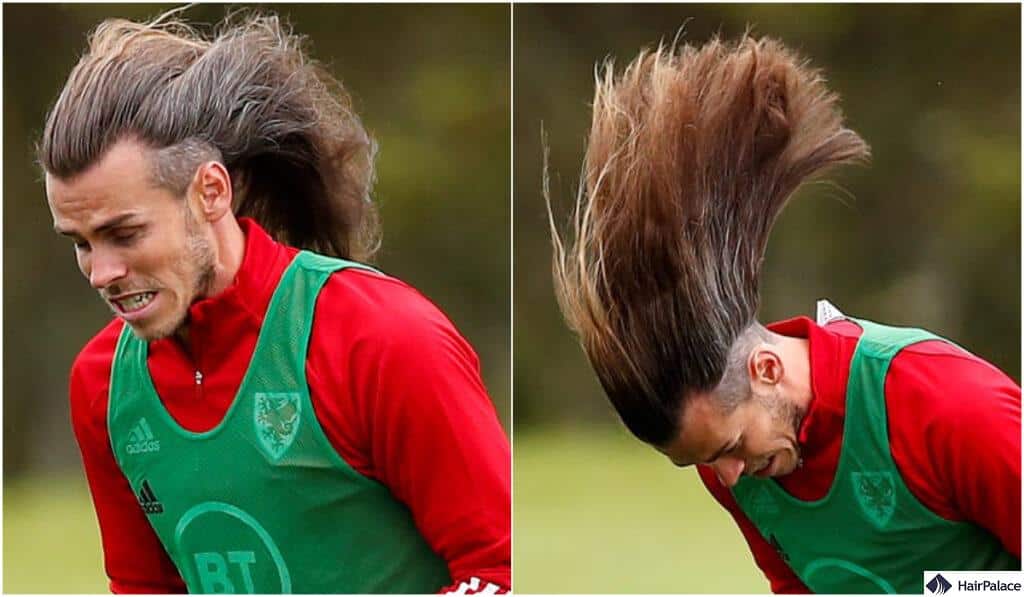 gareth bale hair transplant rumors