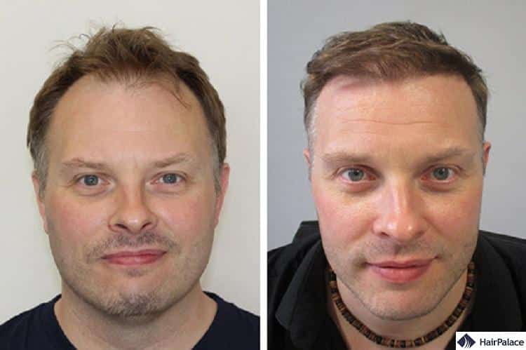 Hair Transplant Dubai | TOP 10 Clinics in 2023 Hair Transplant Dubai | TOP 10 Clinics in 2023