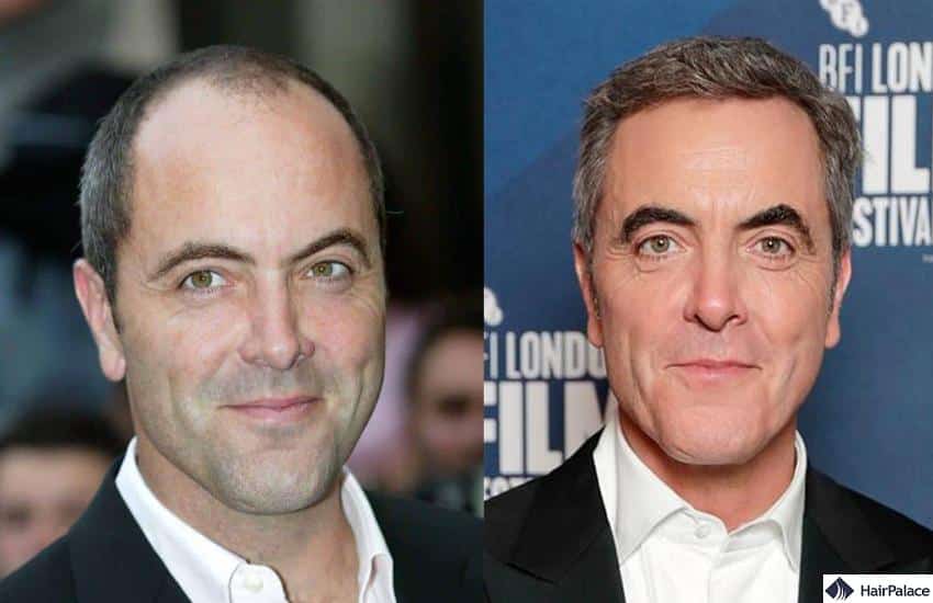 James Nesbitt hair transplant results