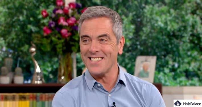 james nesbitt multiple hair transplant