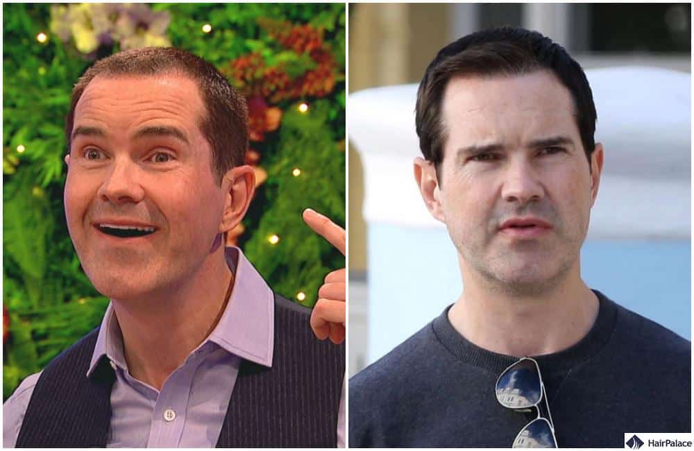 Jimmy Carr hair transplant result