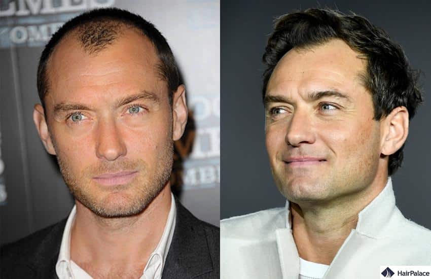 Jude Law hair loss