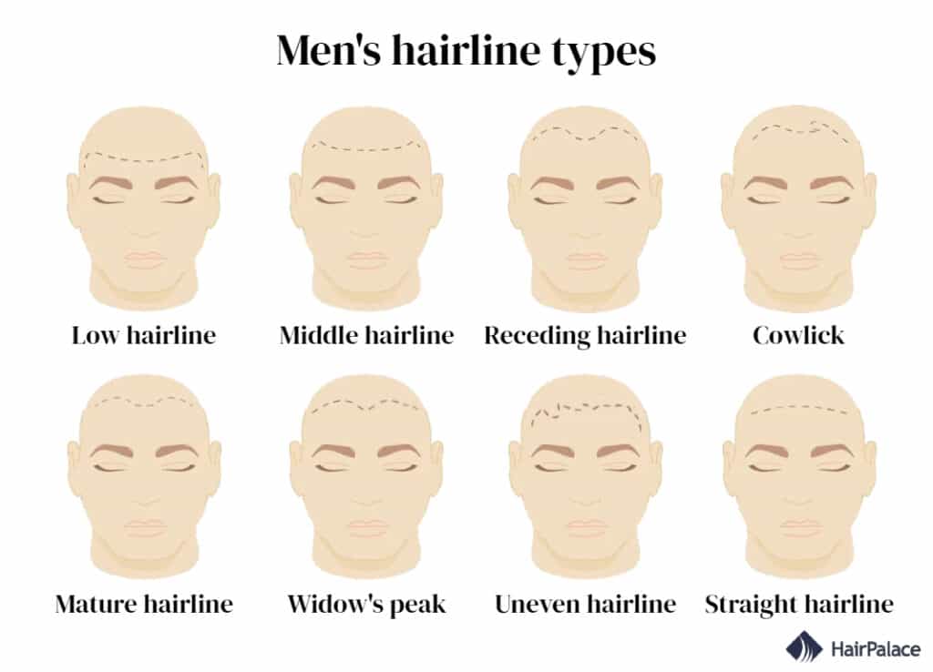 Hairline Types For Men And Women How To Change Yours