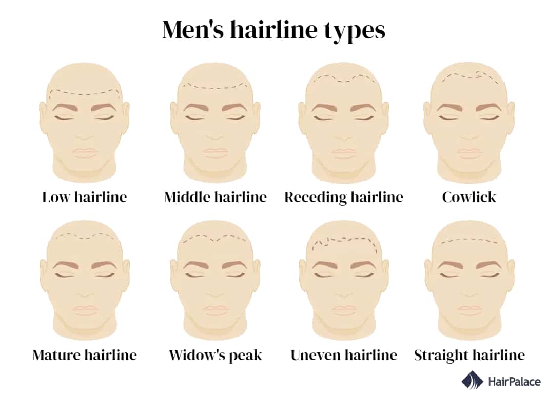 Hairline types for men