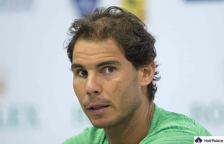 Rafael Nadal hair density