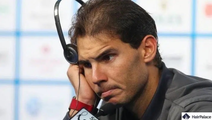 Rafael Nadal hair loss