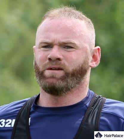 Wayne Rooney going bald again