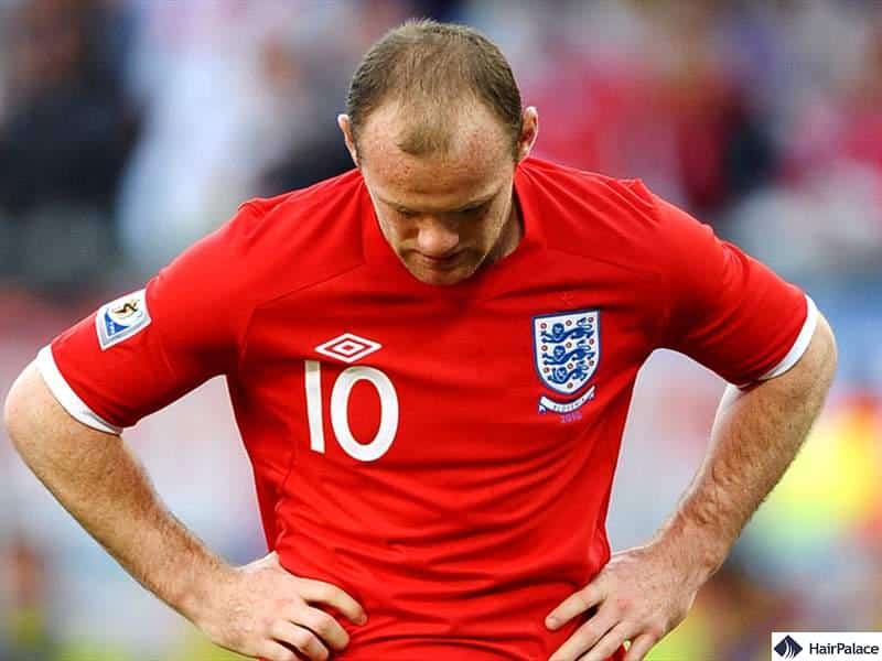 Wayne Rooney balding