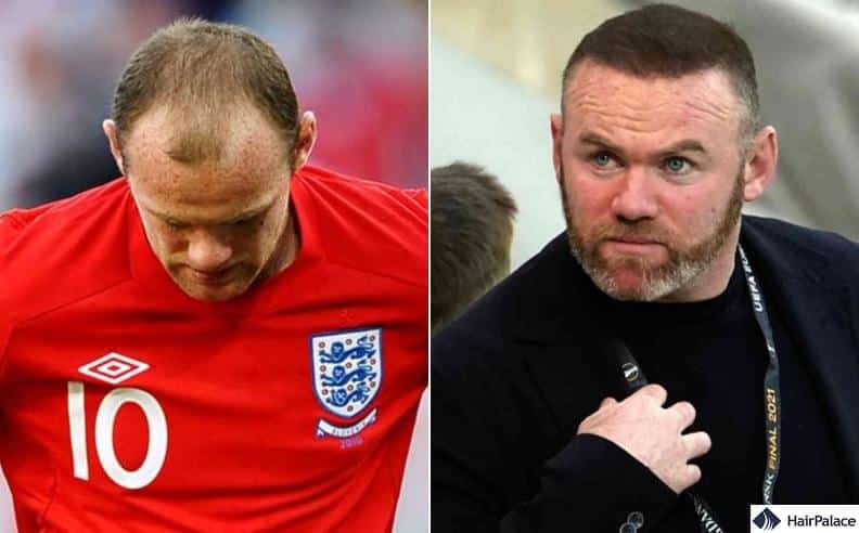 Wayne Rooney hair restoration result