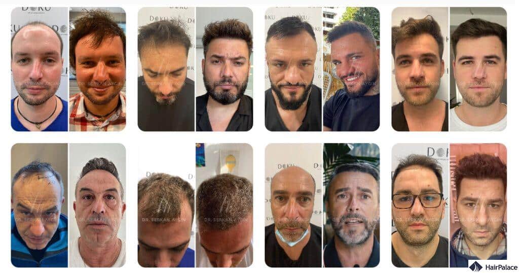 Hair transplant results in turkey