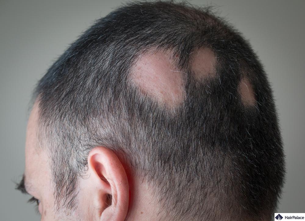 alopecia areata may result in diffuse hair loss