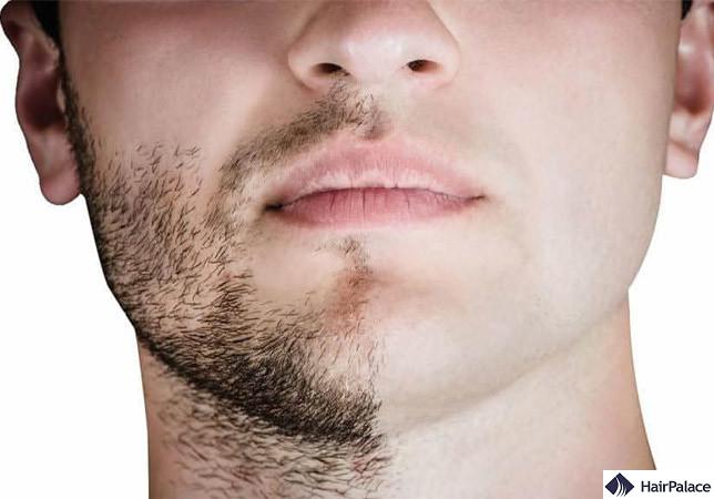 beard hair transplant