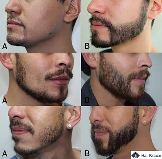 beard hair transplant results before and after surgery