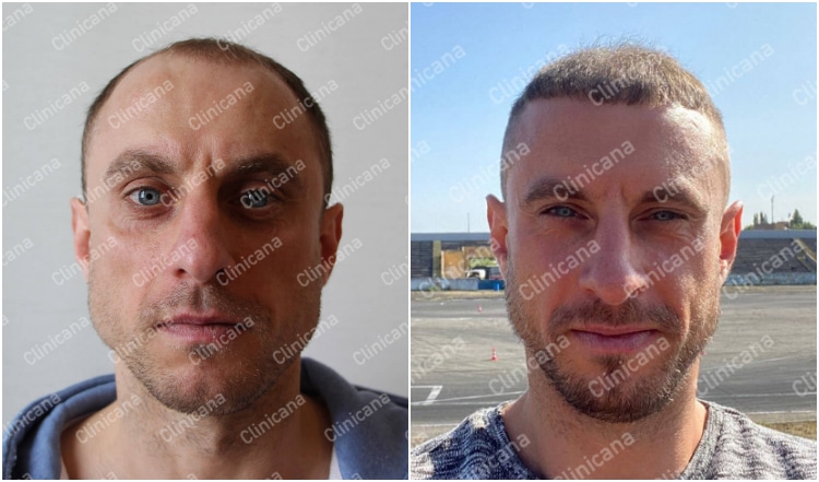 turkey hair transplant results