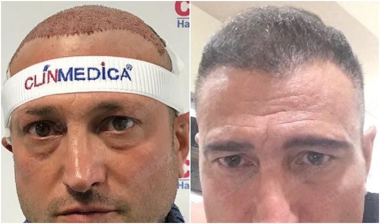 hair transplant turkey before and after