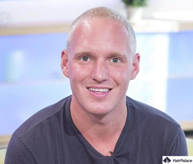 Jamie Laing before hair transplantation