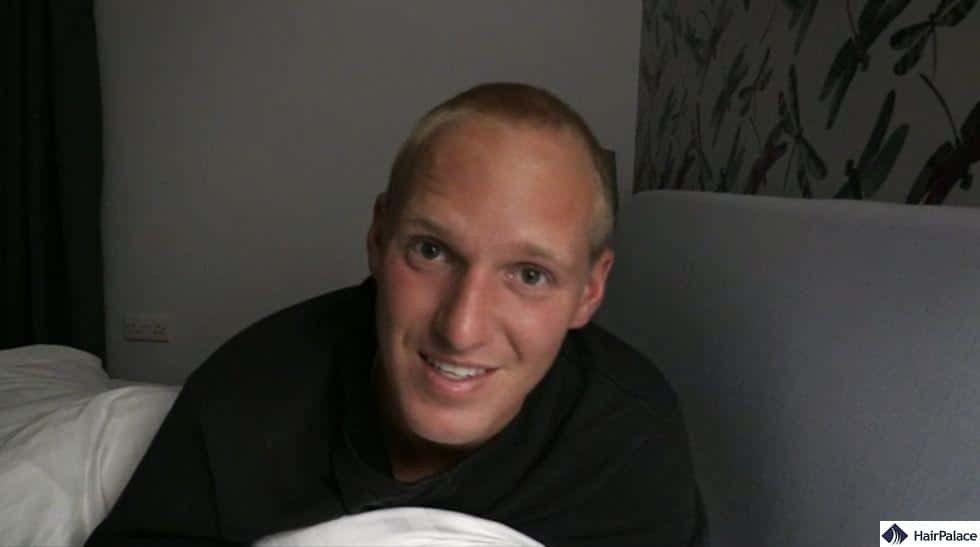 hair loss of jamie laing