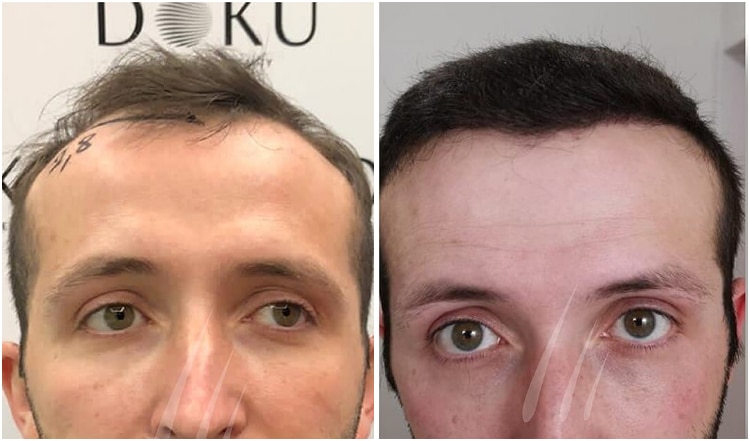 hair transplant before and after turkey