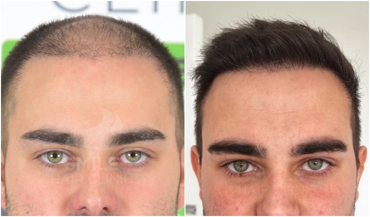 hair transplant turkey results