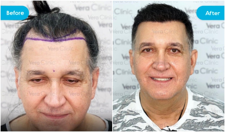 turkey hair transplant before and after