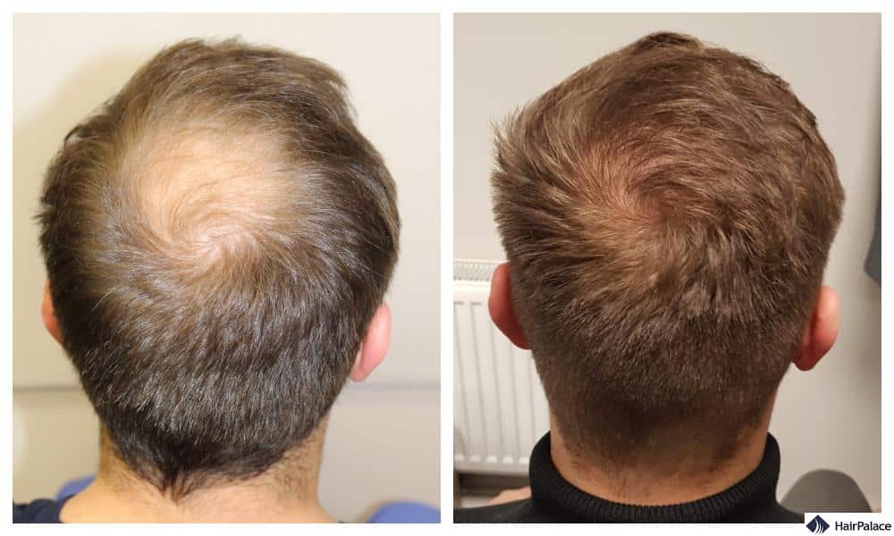 Fut Hair Transplant Tips  Advice From Top Doctors  Lybrate