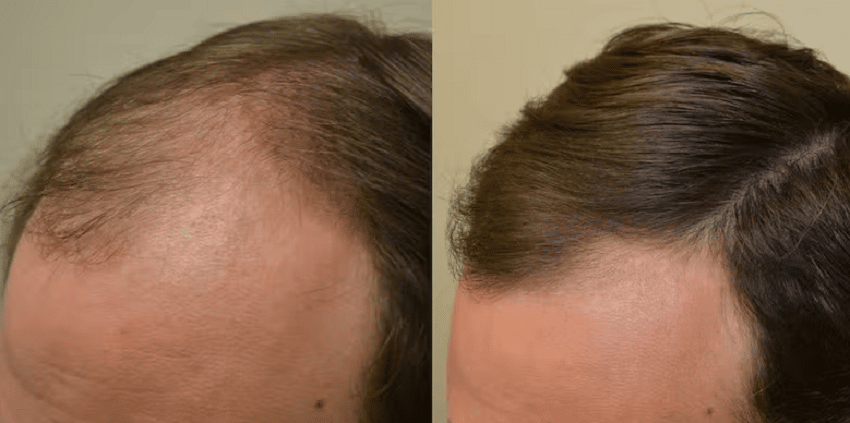 before and after finasteride use