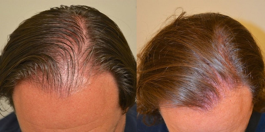 topical finasteride result