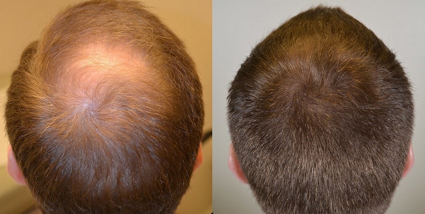 finasteride tablet before after