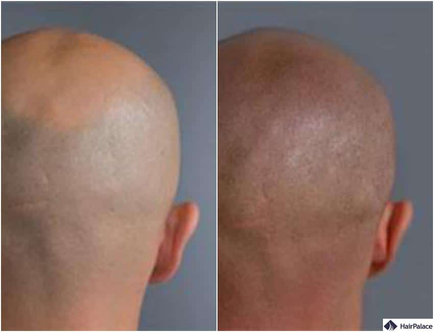 hair tattoo result