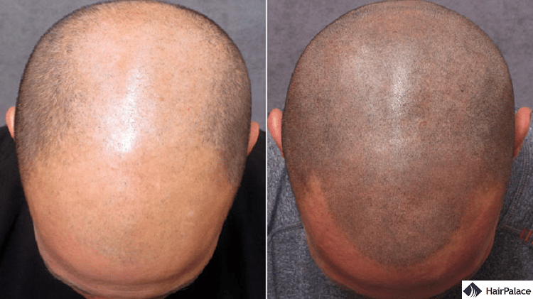 before and after scalp micropigmentation