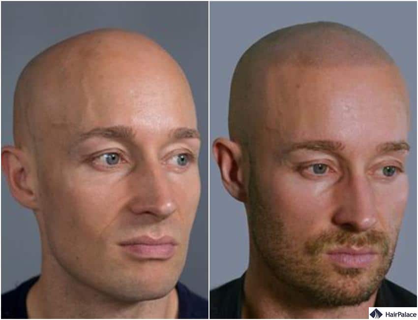 Hair Tattoos Techniques, Ideal Candidates and Aftercare