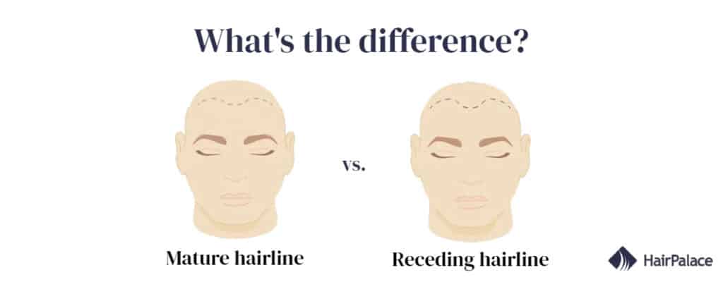 difference between maturing and receding hairline