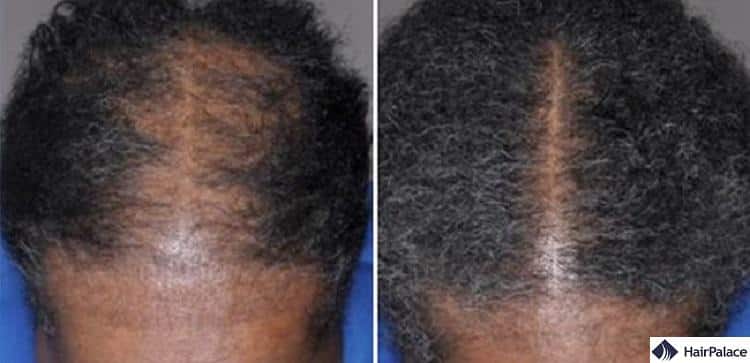regaine before after photo