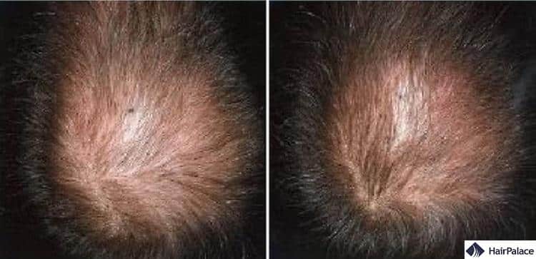 regaine solution before and after