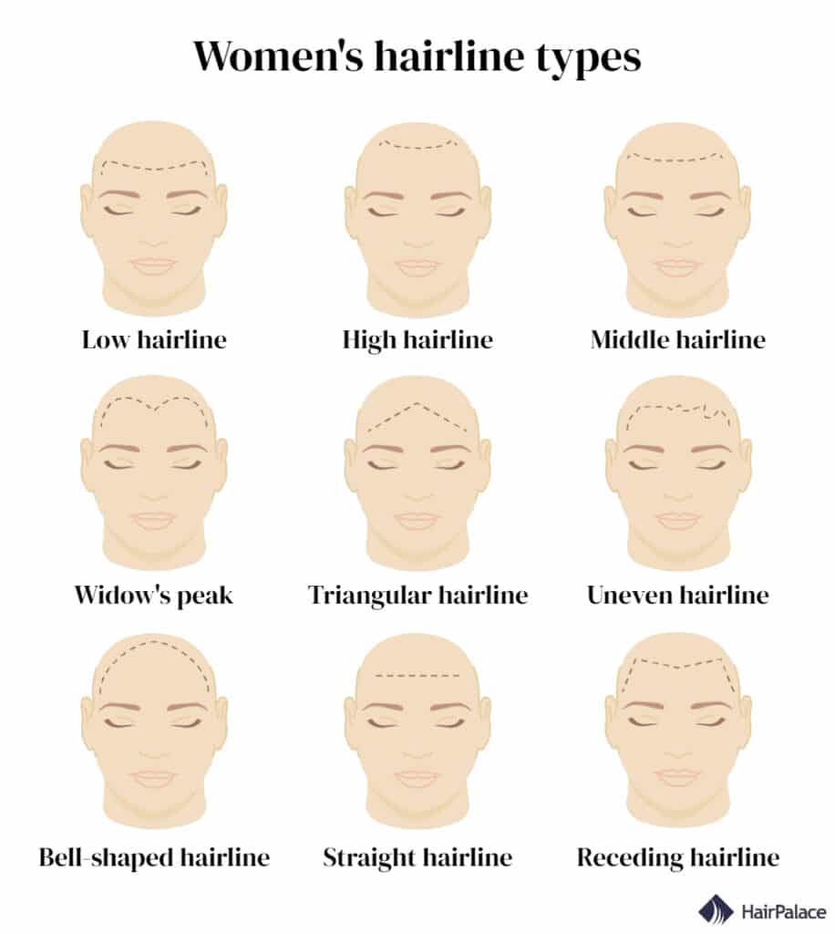types of hairlines in women