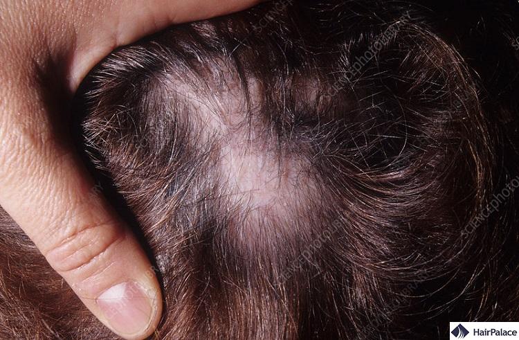 lupus may cause hair loss
