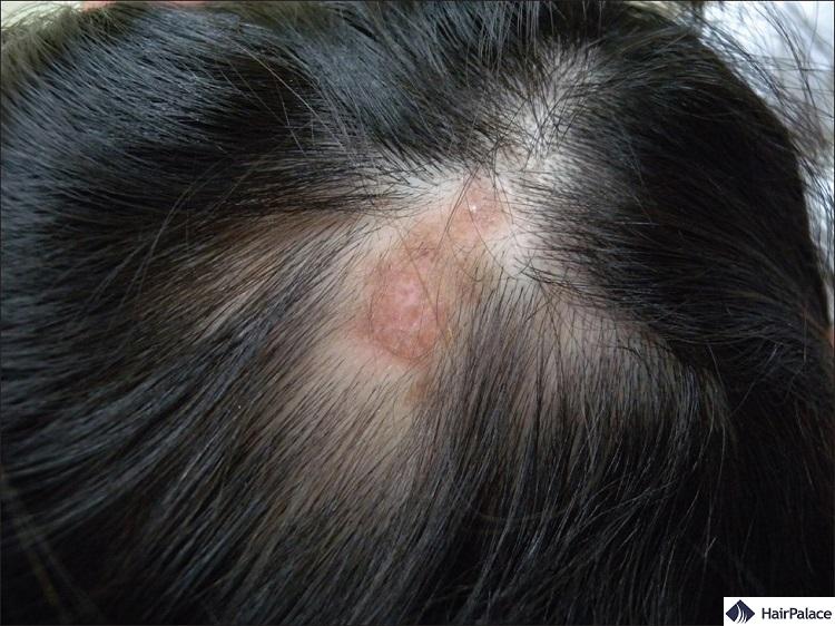 discoid lupus may cause permanent hair loss