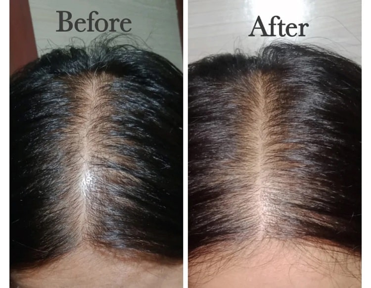 before and after rosemary oil hair growth pictures