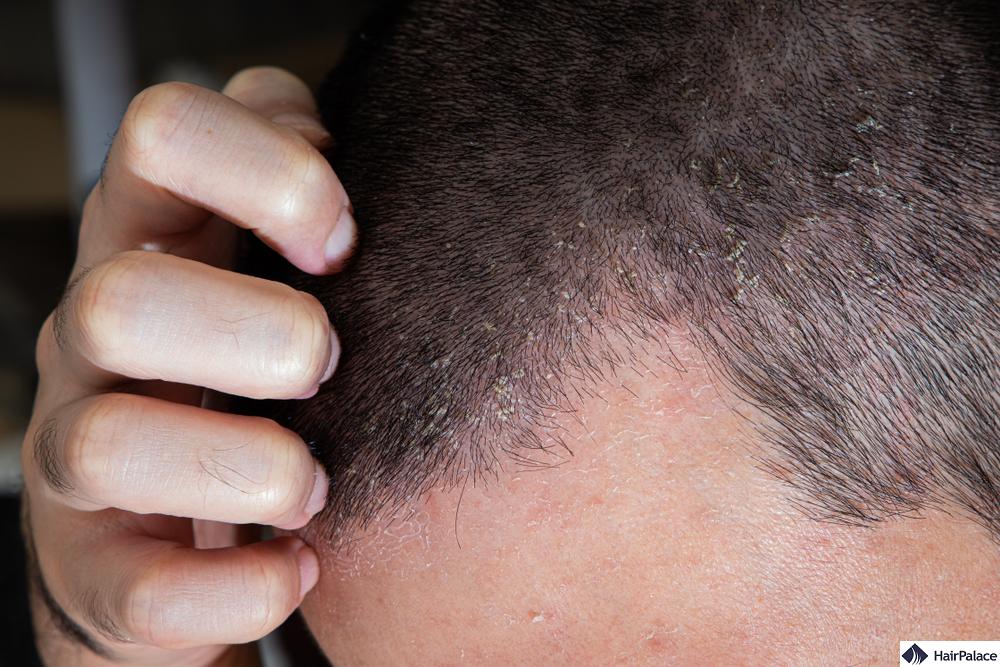 Scalp infection illnesses that cause hair loss