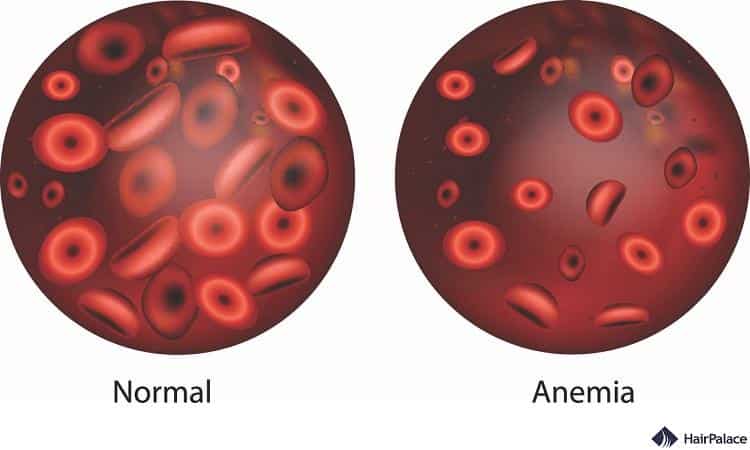 Anaemia hair loss condition