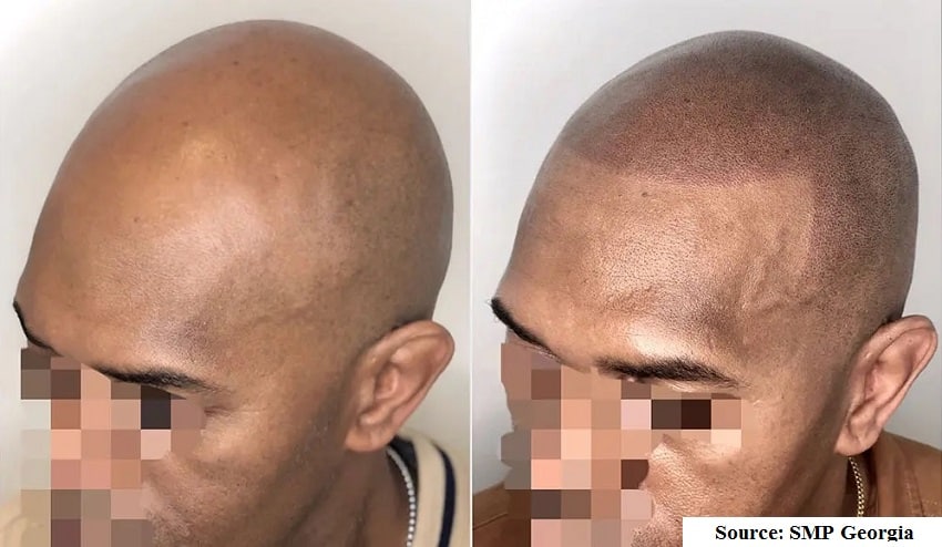scalp micropigmentation after results