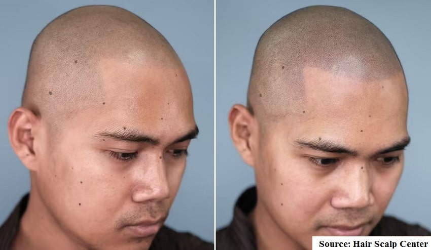 scalp micropigmentation end result